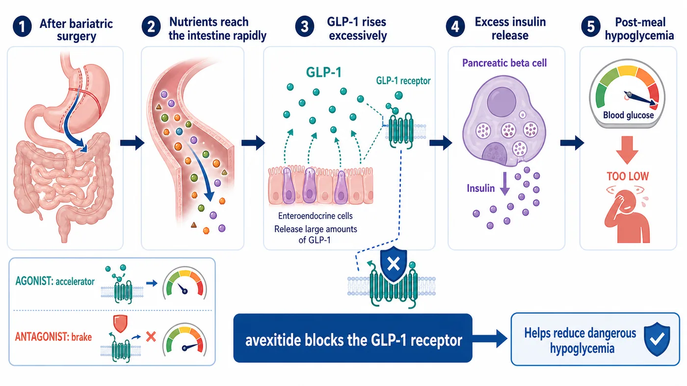 In post-bariatric hypoglycemia, rapid nutrient delivery can drive excessive GLP-1 signaling, an insulin surge and a glucose crash; avexitide blocks the GLP-1 receptor
