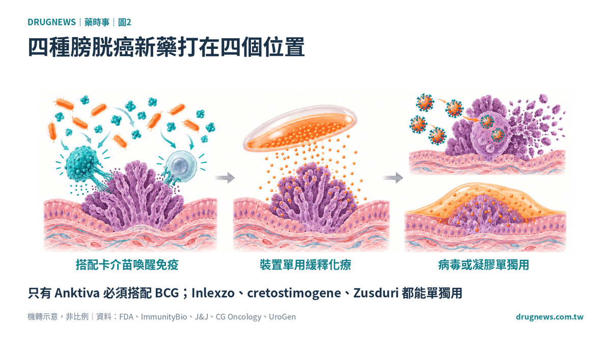 膀胱癌機制圖:Anktiva 叫醒 NK 與 T 細胞並搭配 BCG,Inlexzo 釋放 gemcitabine,cretostimogene 溶瘤病毒,Zusduri mitomycin 凝膠