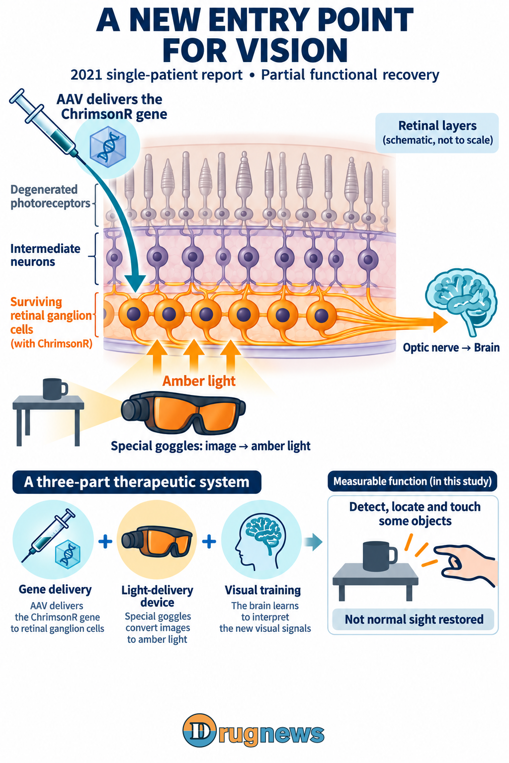 2021 one-patient RP report: AAV/ChrimsonR, amber-light goggles and training; partial functional vision.