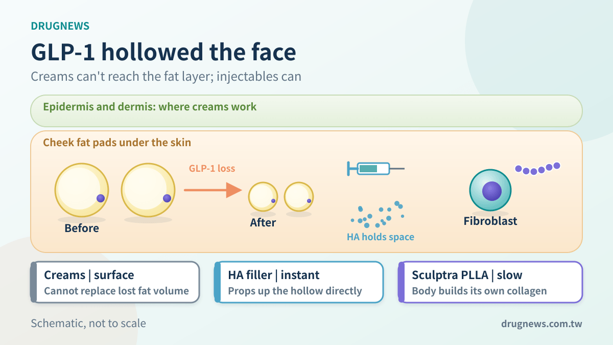 Schematic: GLP-1 drugs shrink cheek fat cells; creams act on the surface while HA fillers and PLLA biostimulators restore volume under the skin